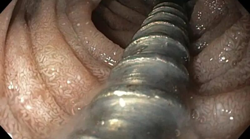 nail-removed-from-stomach-with