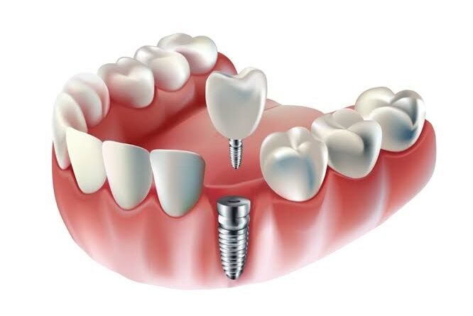 dental-impalnt-easy-now-